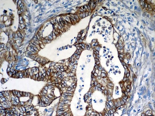 IHC of EGFR on a FFPE Colon Carcinoma Tissue